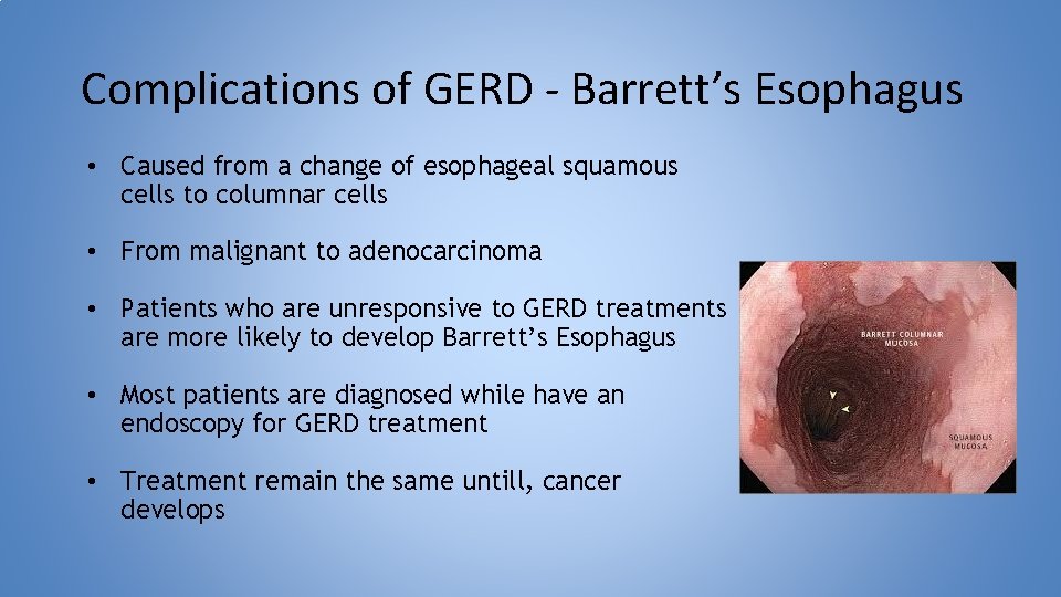 Complications of GERD - Barrett’s Esophagus • Caused from a change of esophageal squamous