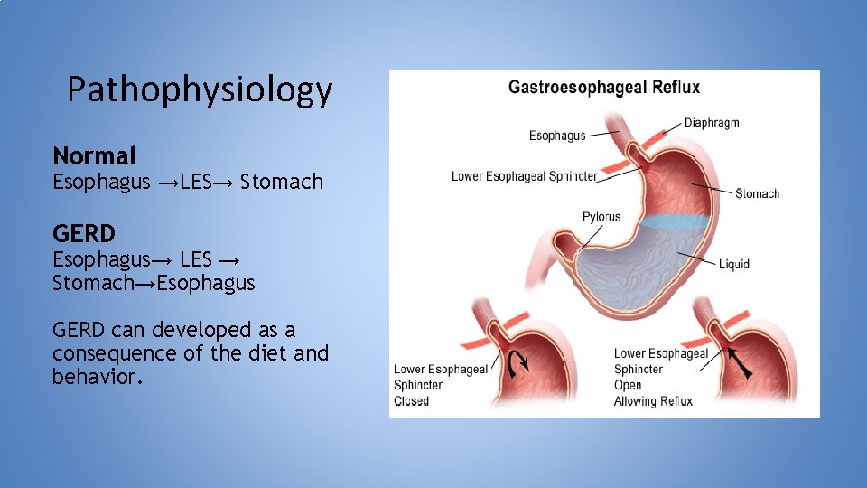 Pathophysiology Normal Esophagus →LES→ Stomach GERD Esophagus→ LES → Stomach→Esophagus GERD can developed as