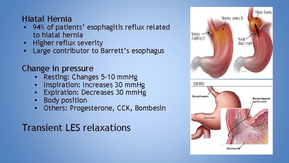 Hiatal Hernia • 94% of patients’ esophagitis reflux related to hiatal hernia • Higher
