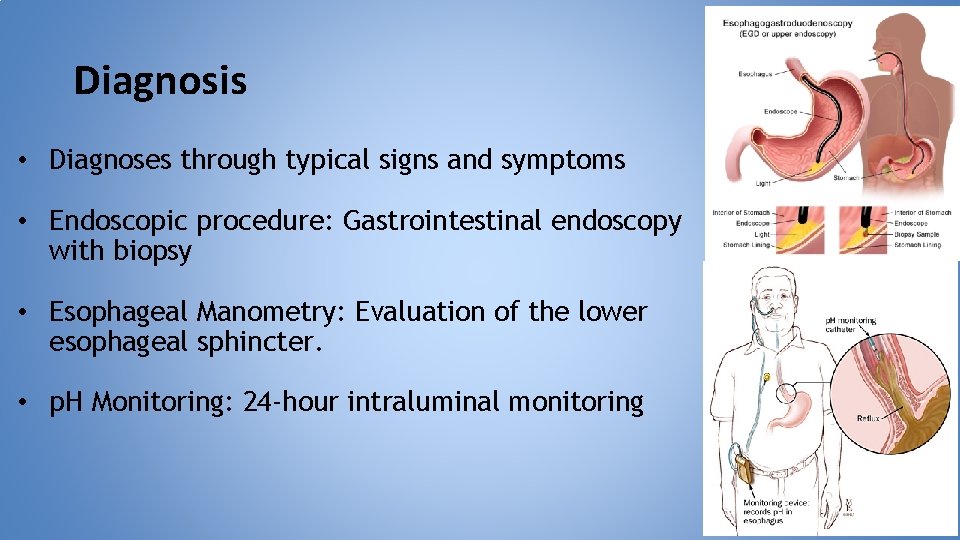 Diagnosis • Diagnoses through typical signs and symptoms • Endoscopic procedure: Gastrointestinal endoscopy with