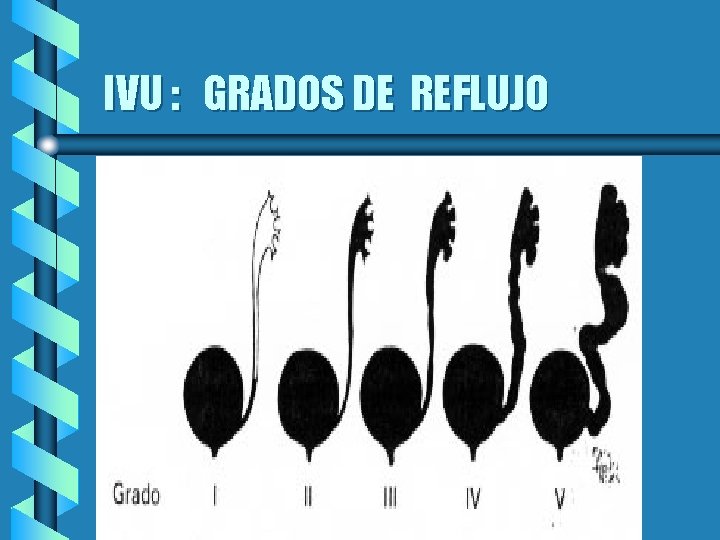 IVU : GRADOS DE REFLUJO 