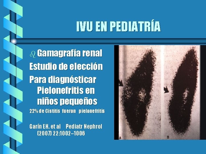 IVU EN PEDIATRÍA b Gamagrafía renal Estudio de elección Para diagnósticar Pielonefritis en niños