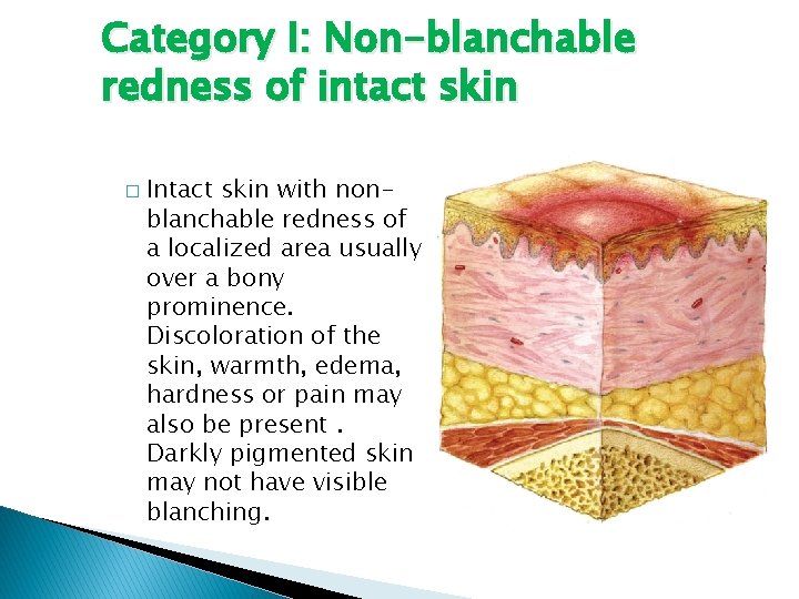 Category I: Non-blanchable redness of intact skin � Intact skin with nonblanchable redness of