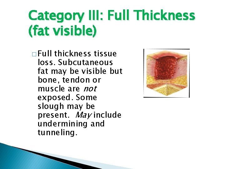 Category III: Full Thickness (fat visible) � Full thickness tissue loss. Subcutaneous fat may