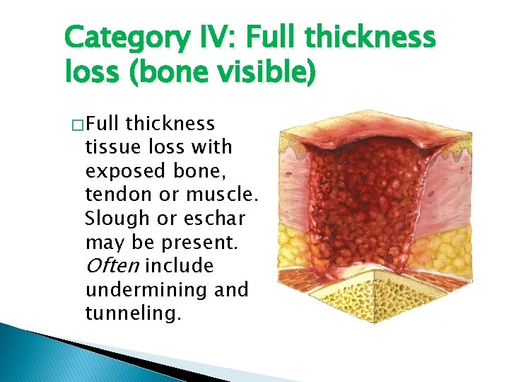 Category IV: Full thickness loss (bone visible) � Full thickness tissue loss with exposed