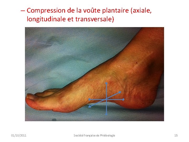 – Compression de la voûte plantaire (axiale, longitudinale et transversale) 01/10/2011 Société française de