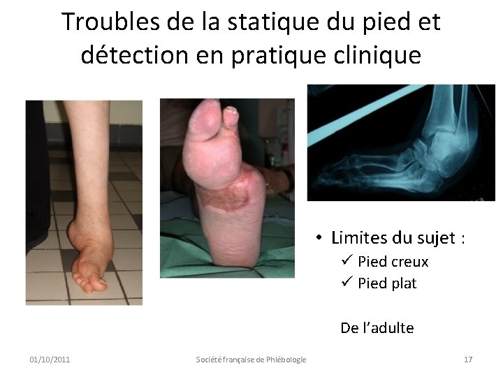 Troubles de la statique du pied et détection en pratique clinique • Limites du