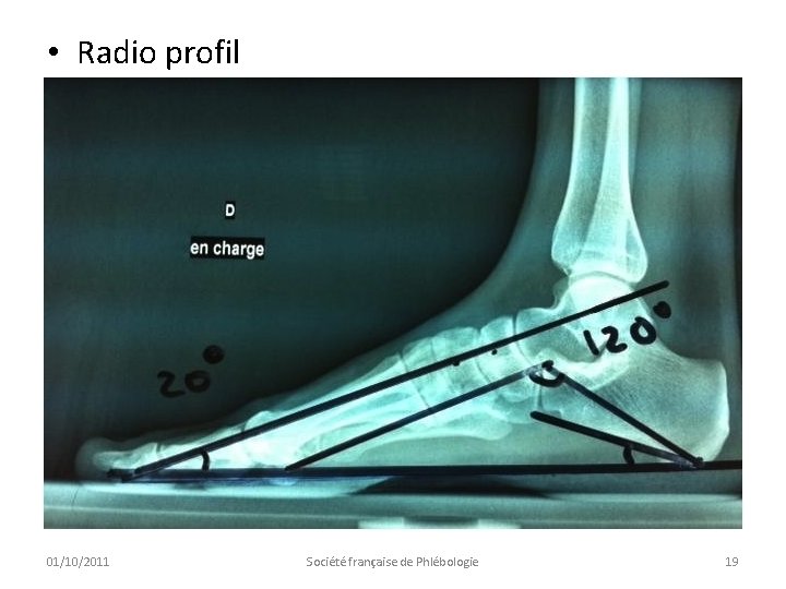  • Radio profil 01/10/2011 Société française de Phlébologie 19 