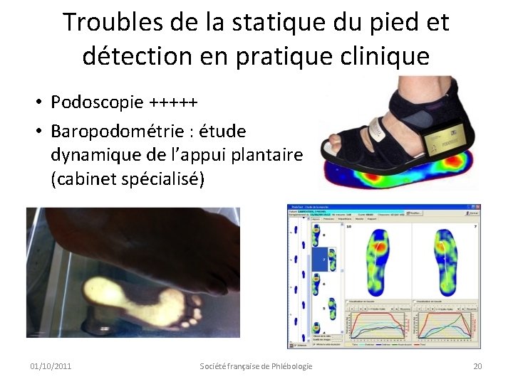 Troubles de la statique du pied et détection en pratique clinique • Podoscopie +++++