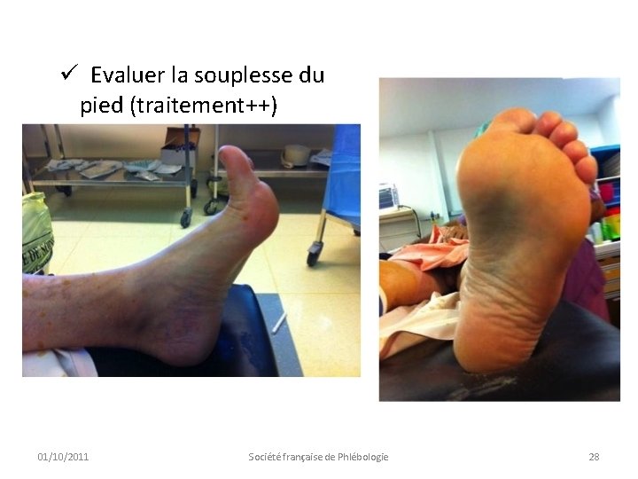 ü Evaluer la souplesse du pied (traitement++) 01/10/2011 Société française de Phlébologie 28 