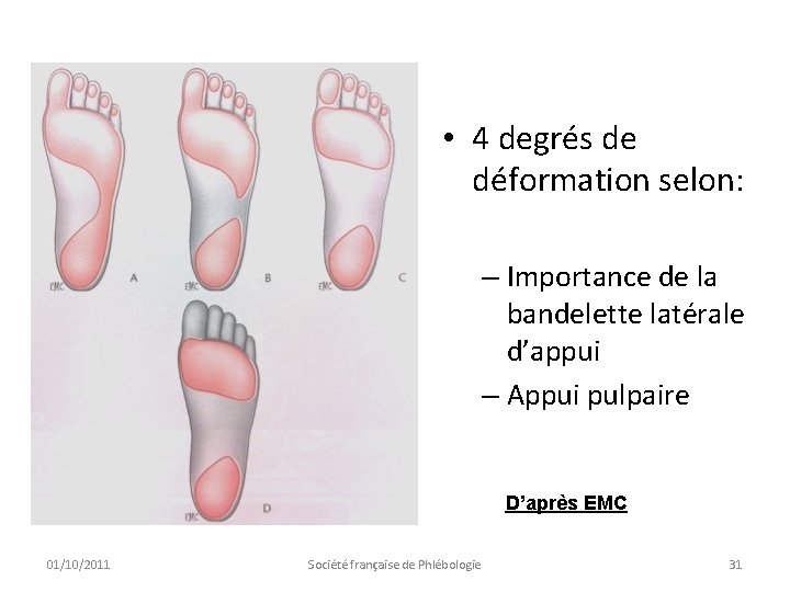  • 4 degrés de déformation selon: – Importance de la bandelette latérale d’appui