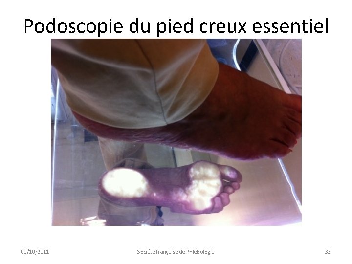 Podoscopie du pied creux essentiel 01/10/2011 Société française de Phlébologie 33 