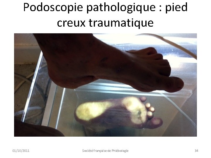 Podoscopie pathologique : pied creux traumatique 01/10/2011 Société française de Phlébologie 34 