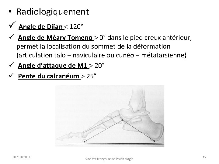  • Radiologiquement ü Angle de Djian < 120° ü Angle de Méary Tomeno