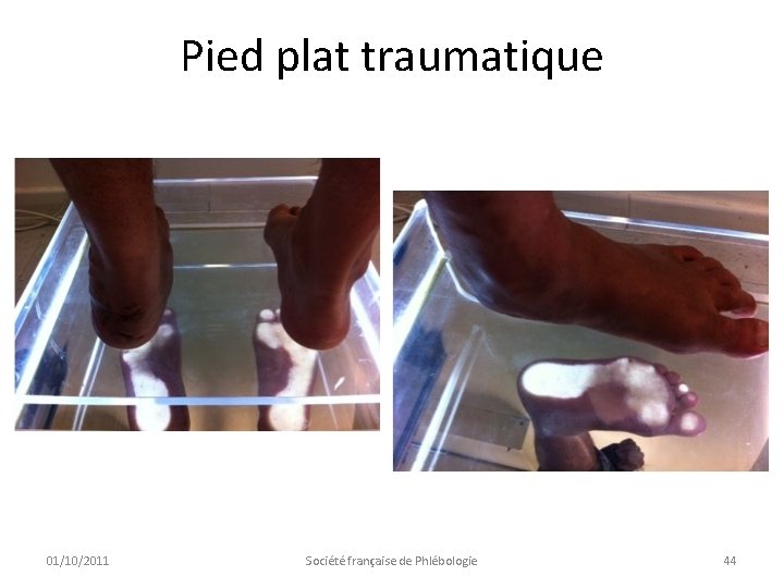 Pied plat traumatique 01/10/2011 Société française de Phlébologie 44 