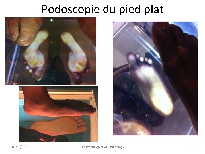 Podoscopie du pied plat 01/10/2011 Société française de Phlébologie 45 