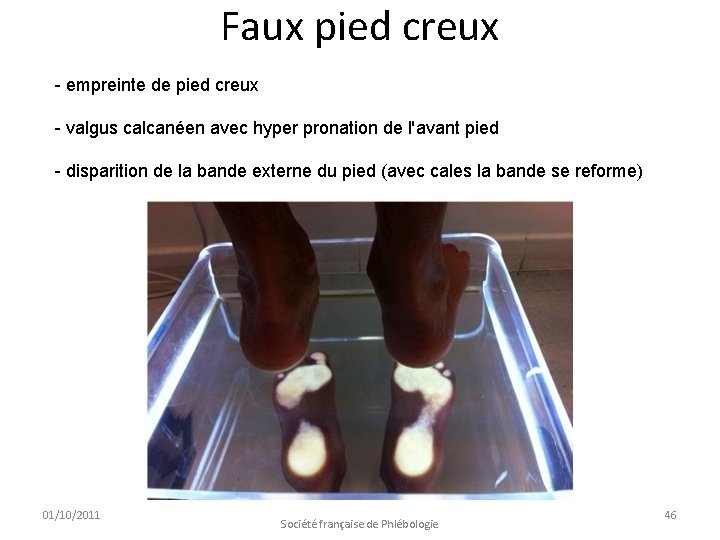 Faux pied creux - empreinte de pied creux - valgus calcanéen avec hyper pronation