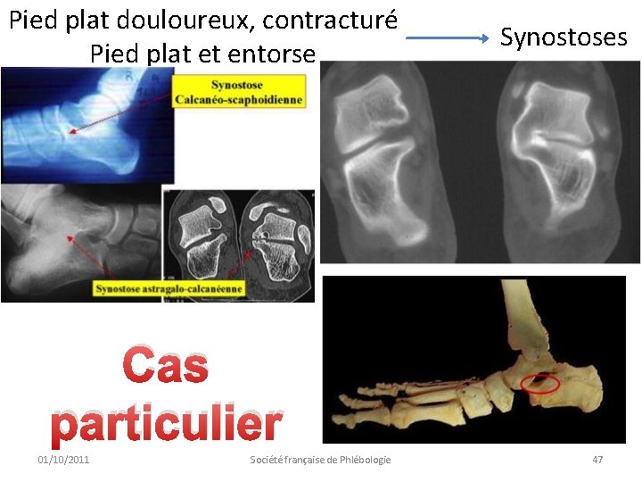 Pied plat douloureux, contracturé Pied plat et entorse Synostoses Cas particulier 01/10/2011 Société française