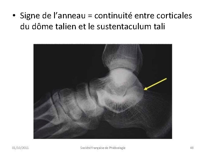  • Signe de l’anneau = continuité entre corticales du dôme talien et le