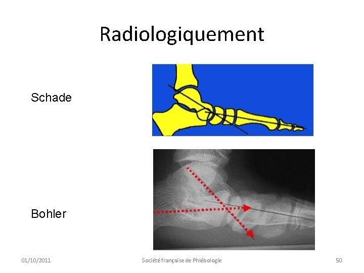 Radiologiquement Schade Djian Bohler 01/10/2011 Société française de Phlébologie 50 