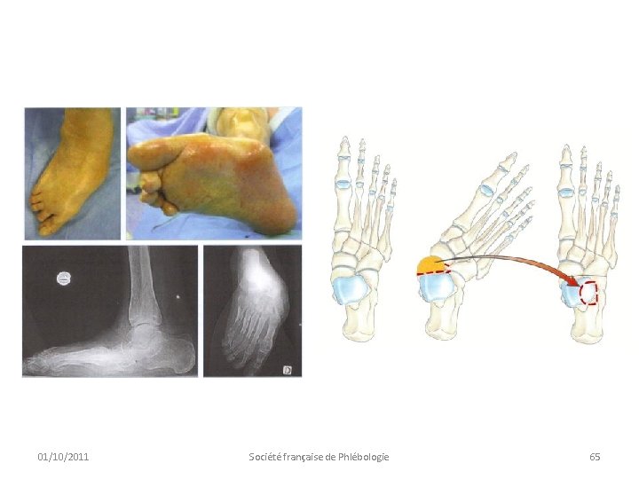 01/10/2011 Société française de Phlébologie 65 