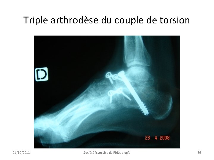 Triple arthrodèse du couple de torsion 01/10/2011 Société française de Phlébologie 66 