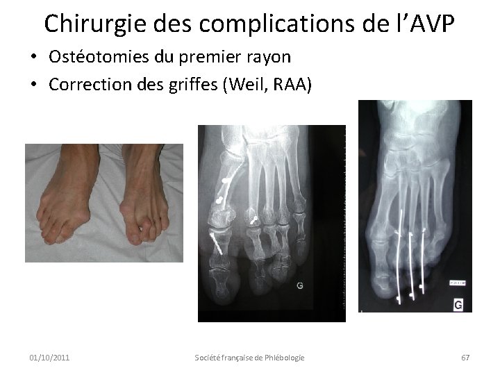 Chirurgie des complications de l’AVP • Ostéotomies du premier rayon • Correction des griffes