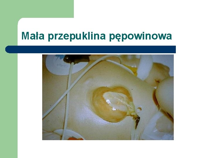 Mała przepuklina pępowinowa 