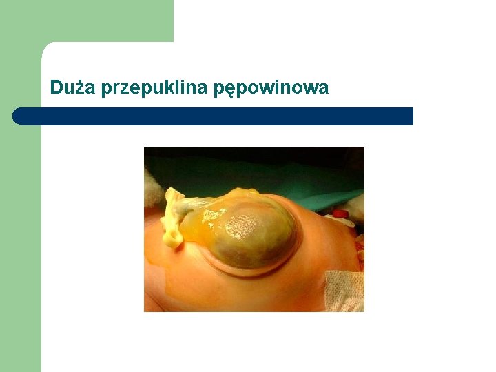 Duża przepuklina pępowinowa 