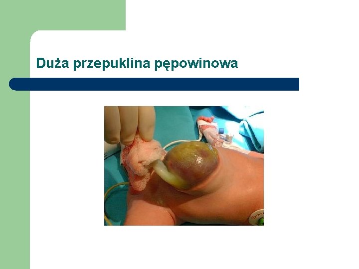 Duża przepuklina pępowinowa 
