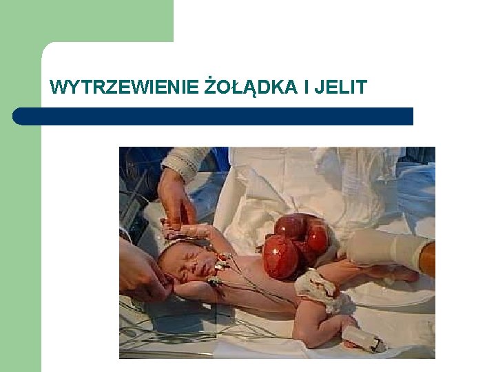 WYTRZEWIENIE ŻOŁĄDKA I JELIT 