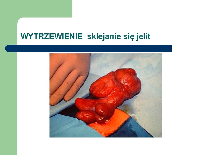 WYTRZEWIENIE sklejanie się jelit 