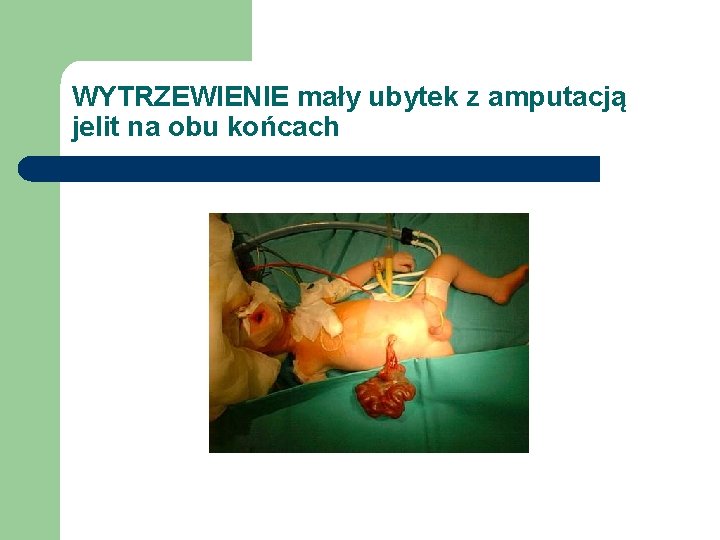 WYTRZEWIENIE mały ubytek z amputacją jelit na obu końcach 