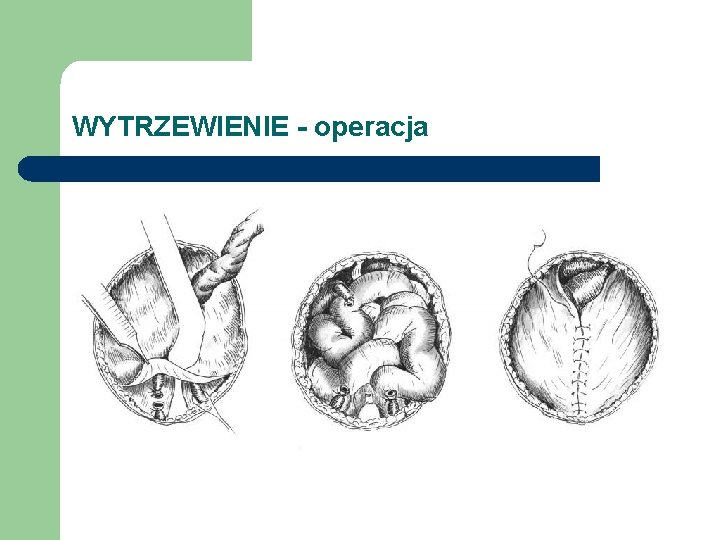 WYTRZEWIENIE - operacja 