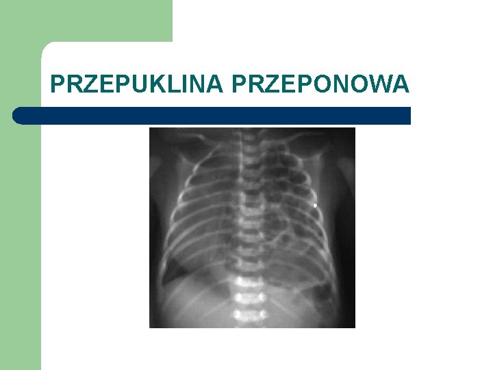 PRZEPUKLINA PRZEPONOWA 