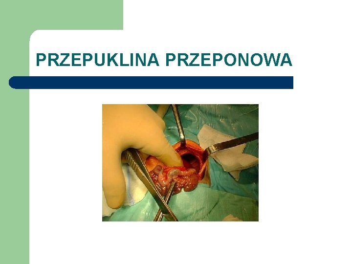 PRZEPUKLINA PRZEPONOWA 