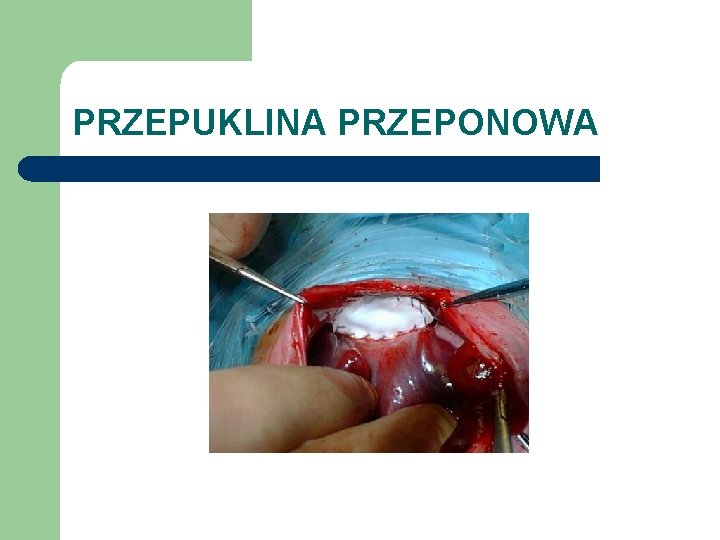 PRZEPUKLINA PRZEPONOWA 