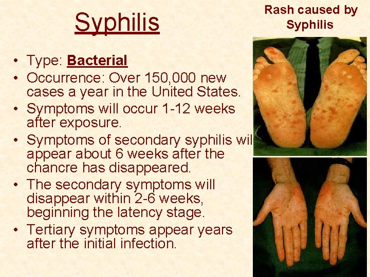 Syphilis • Type: Bacterial • Occurrence: Over 150, 000 new cases a year in