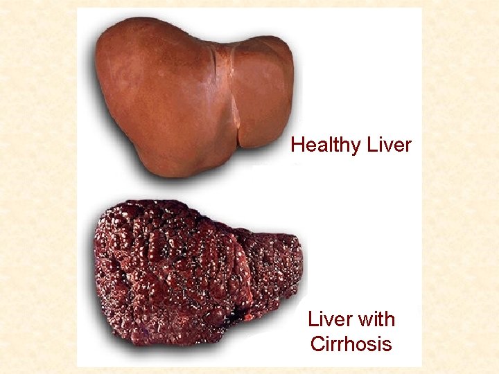 Healthy Liver with Cirrhosis 