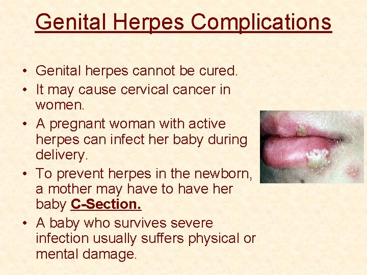 Genital Herpes Complications • Genital herpes cannot be cured. • It may cause cervical