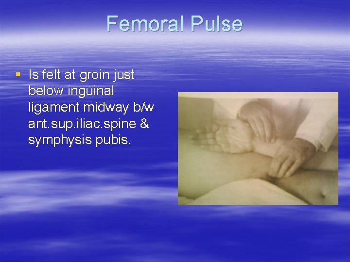 Femoral Pulse § Is felt at groin just below inguinal ligament midway b/w ant.