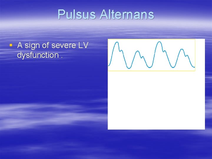 Pulsus Alternans § A sign of severe LV dysfunction. 