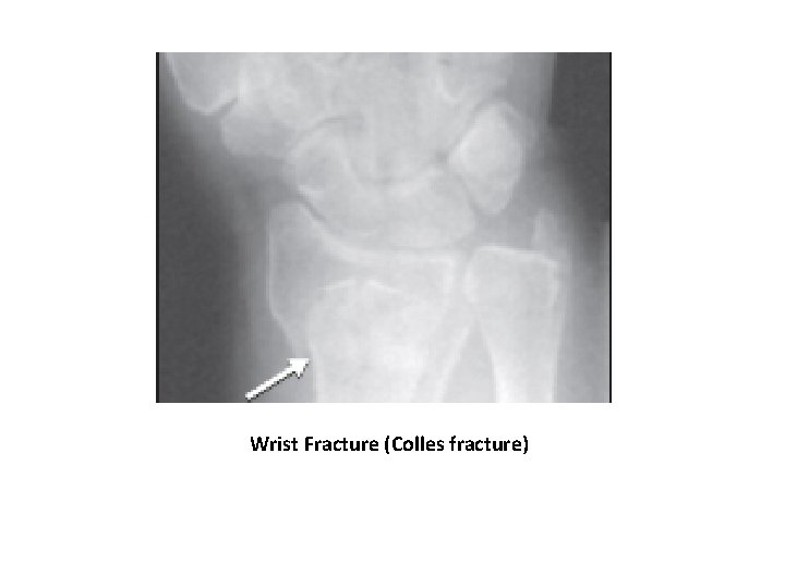 Where Is R Colles OSTEOPOROSIS Dr K K Sawlani Department of Medicine