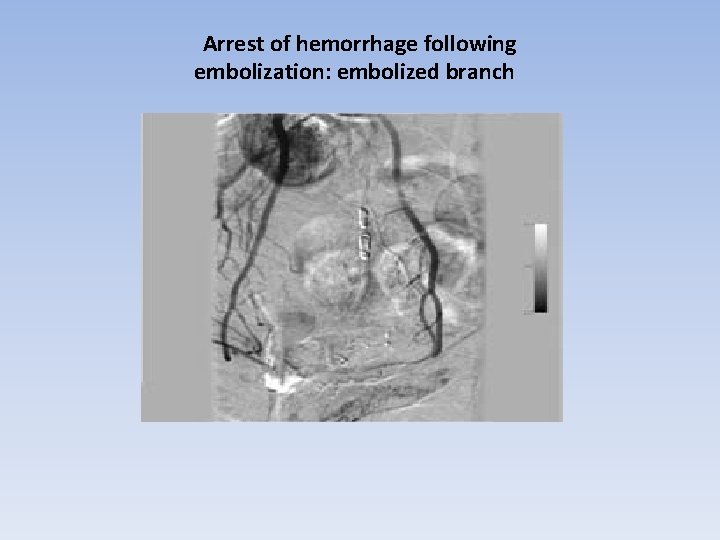 Arrest of hemorrhage following embolization: embolized branch 