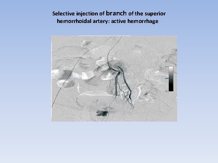 Selective injection of branch of the superior hemorrhoidal artery: active hemorrhage 