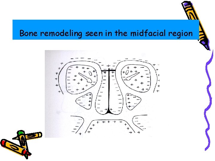 Bone remodeling seen in the midfacial region 