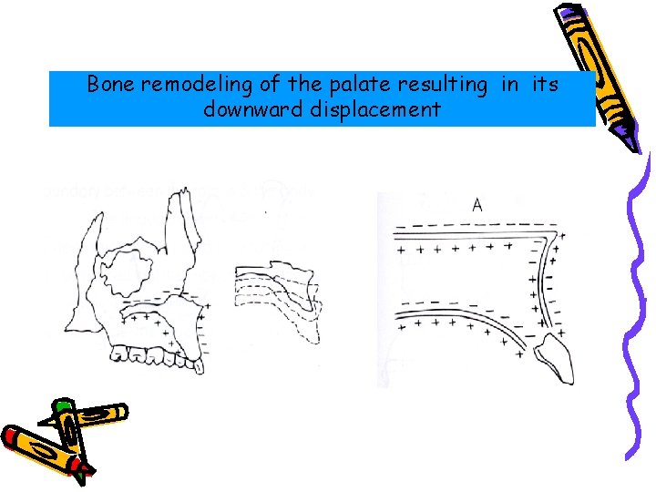 Bone remodeling of the palate resulting in its downward displacement 