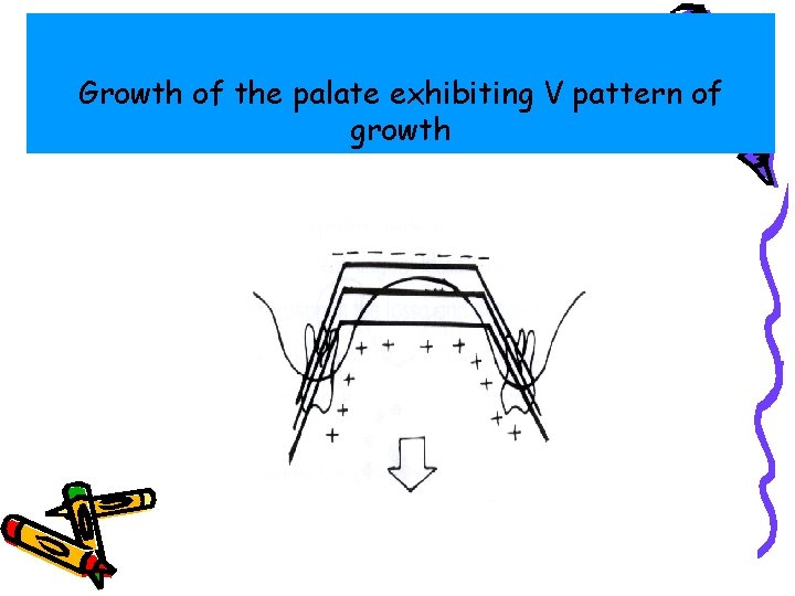 Growth of the palate exhibiting V pattern of growth 