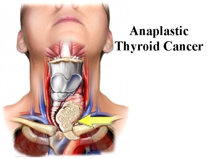 Anaplastic Thyroid Cancer 