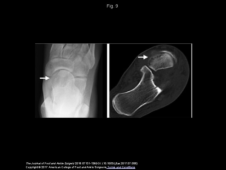 Fig. 9 The Journal of Foot and Ankle Surgery 2018 57131 -139 DOI: (10.